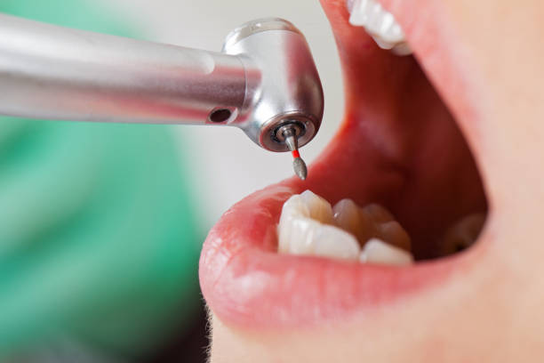 Best Emergency Tooth Extraction in Flatwoods, KY